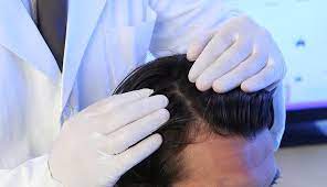 AHPSI, en que consiste nuestro  programa de hair loss specialist certification.